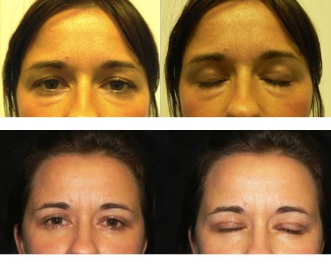 blepharoplasty-uppera blepharoplasty upper