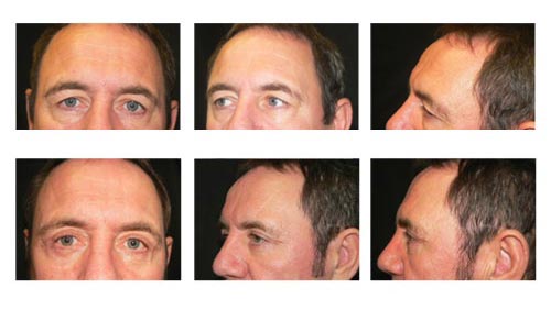 blepharoplasty1a blepharoplasty New York