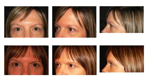 blepharoplasty2a blepharoplasty NYC