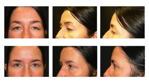 blepharoplasty3a Eyelid Surgery NYC
