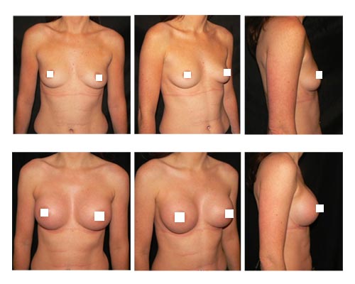 breast-augmentation1