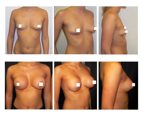 breast-augmentation2