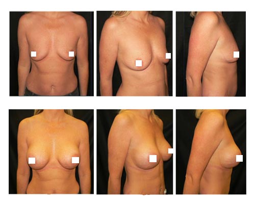 breast-augmentation3
