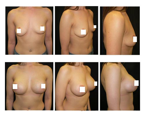 breast-augmentation4