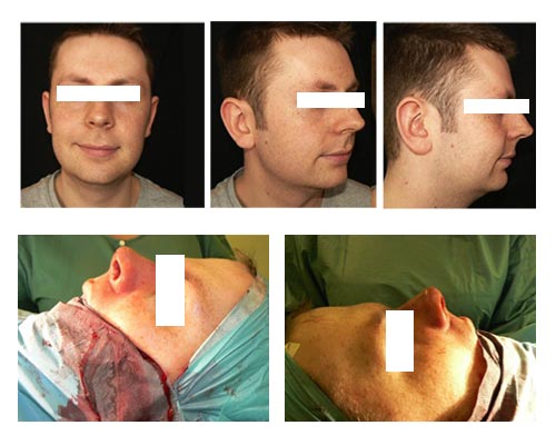 rhinoplasty1 rhinoplasty nyc