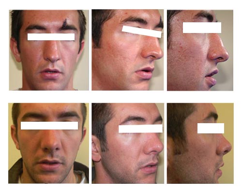 rhinoplasty2 rhinoplasty new york