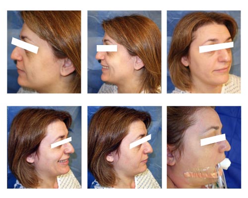 rhinoplasty3 nose job surgery nyc