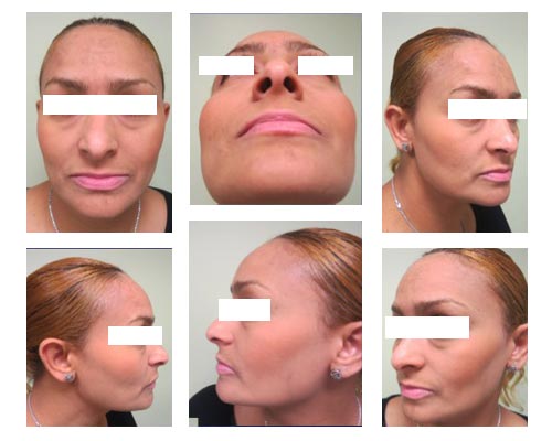 rhinoplasty4 rhinoplasty