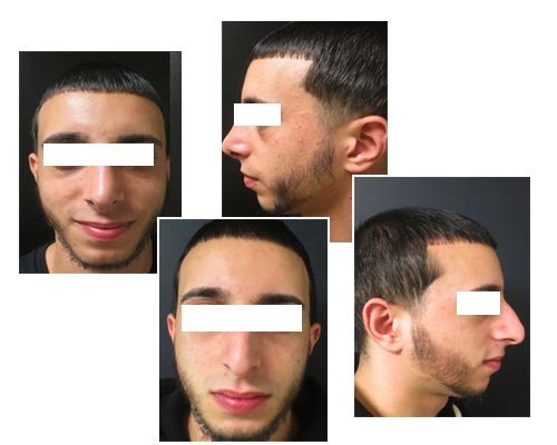 rhinoplasty5 nose job surgery