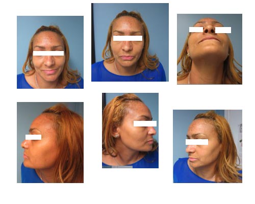 rhinoplasty6 nose job surgery